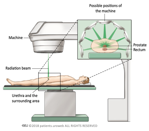 Setup da radioterapia para câncer de próstata: A imagem ilustra o paciente posicionado cuidadosamente na mesa de tratamento, com o acelerador linear emitindo feixes de radiação de alta energia com precisão guiada diretamente para a glândula prostática e áreas adjacentes, como o reto, utilizando múltiplos ângulos para maximizar a dose no tumor e proteger tecidos saudáveis. Representa o planejamento radioterápico avançado no tratamento oncológico