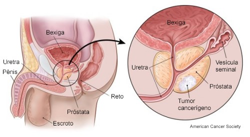 Diagrama da anatomia pélvica masculina mostrando a próstata, bexiga, uretra e um câncer de próstata