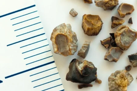 Cálculo Renal_ Guia completo para pacientes