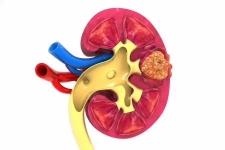 Câncer de rim_Guia completo para pacientes