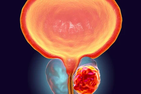 Prevenção Câncer de Próstata