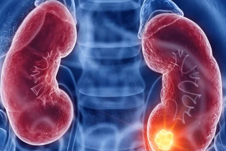Prevenção de Câncer de Rim