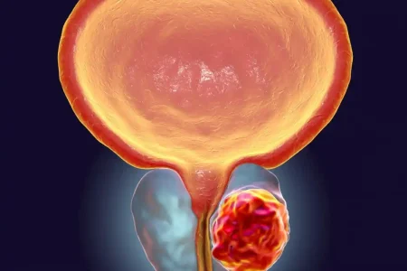 SEO - Câncer de Próstata Guia Completo sobre Sintomas, Diagnóstico e Tratamento (Grande)
