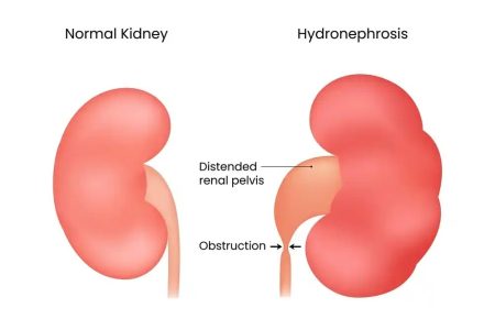 SEO-Estenose-da-Juncao-Ureteropelvica-JUP-Sintomas-Diagnostico-e-Cirurgia